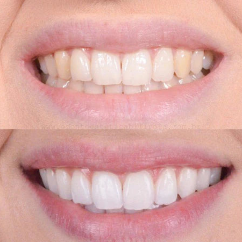BrightNow – Instant Teeth Whitening for a Radiant Smile