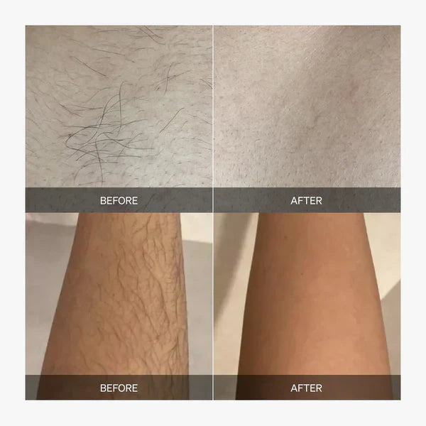 SmoothBeam – Full-Body Hair Removal Device