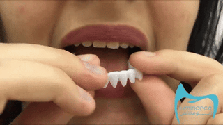 SmileEase – Hassle-Free Snap-On Dentures