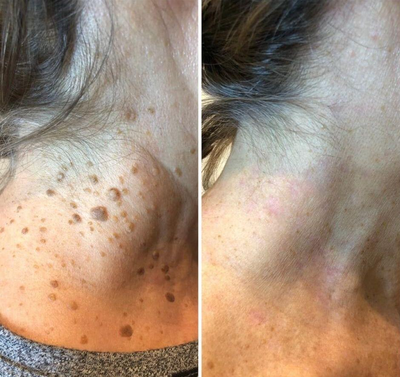 ChillErase – Smooth Skin Renewal Spray