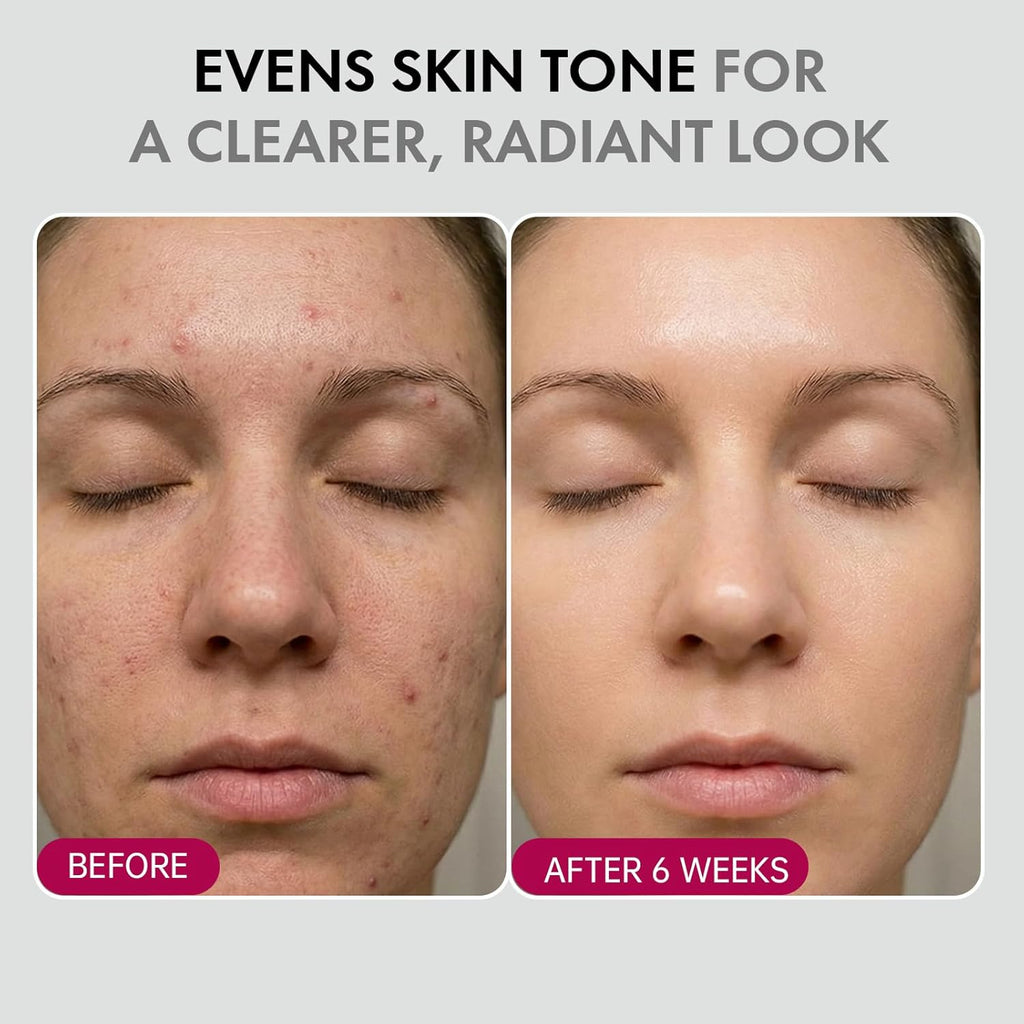 ✨ Spot Removal | Acne Treatment | Anti-Aging | Melanin Reduction | Skin Smoothing | Hydrating | Brightening & Fine Line Diminishing | Skin Renewing Cream