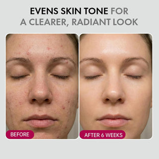 ✨ Spot Removal | Acne Treatment | Anti-Aging | Melanin Reduction | Skin Smoothing | Hydrating | Brightening & Fine Line Diminishing | Skin Renewing Cream