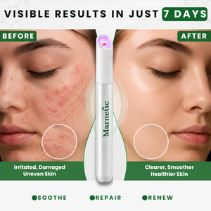 ✨VelvetSkin+™ All-in-One CO₂ Laser Eraser Pen | Removes Moles, Warts, Skin Flaws & Pigmentation
