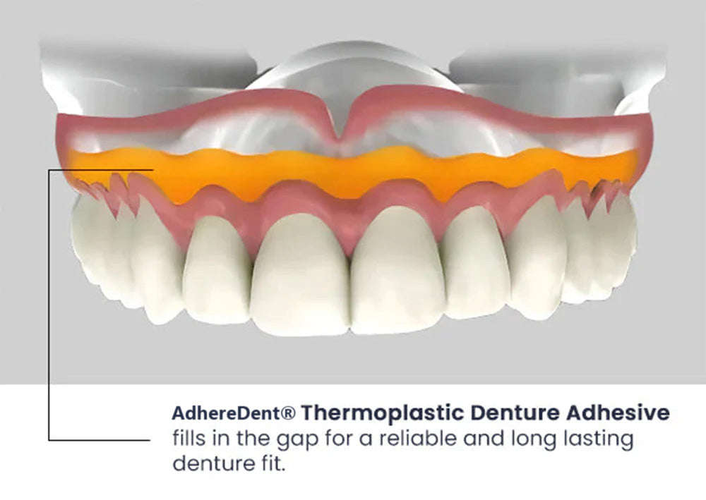 SureBond Adhesive - Durable Retention, Lasting Comfort