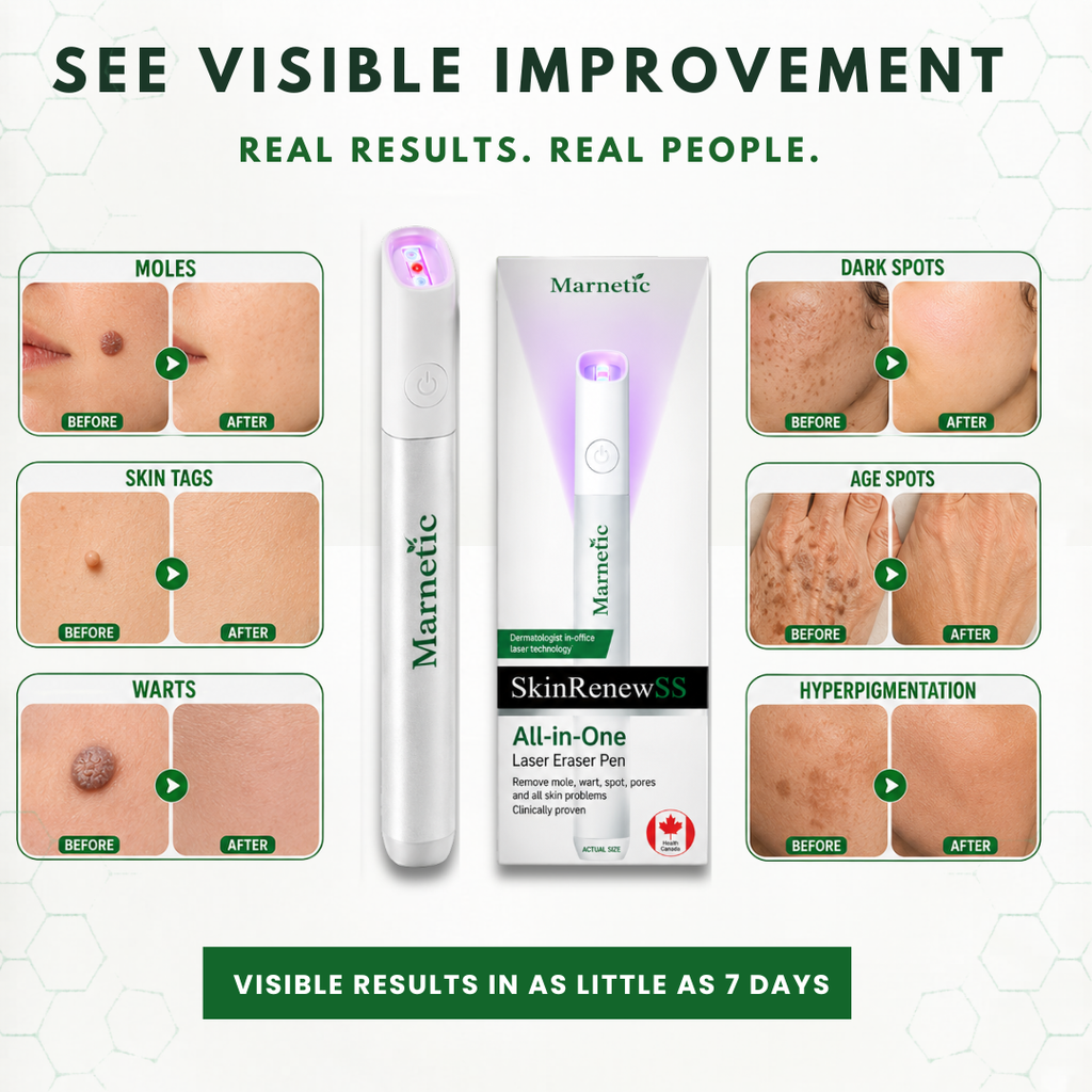 SkinRenew – All-in-One CO₂ Laser Eraser Pen