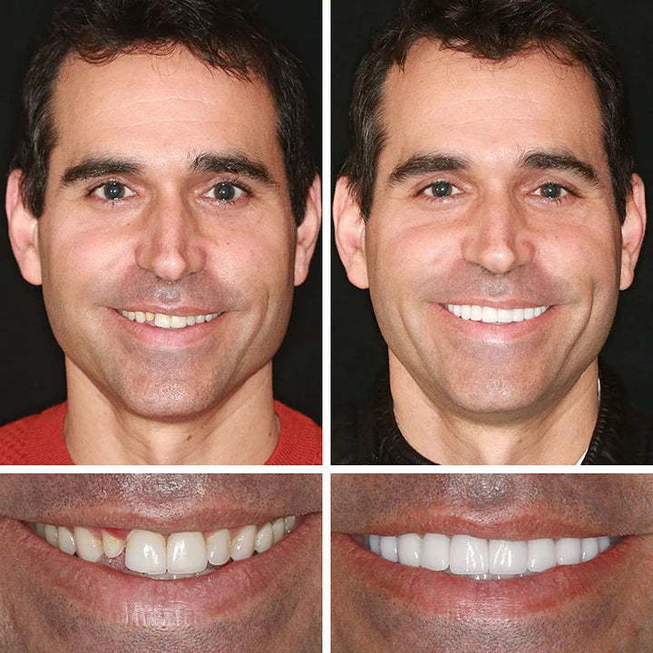 SmileAura - Natural Look Dentures