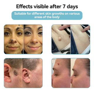 ✨VelvetSkin+™ All-in-One CO₂ Laser Eraser Pen | Removes Moles, Warts, Skin Flaws & Pigmentation
