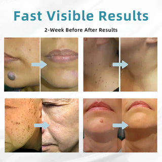 ✨VelvetSkin+™ All-in-One CO₂ Laser Eraser Pen | Removes Moles, Warts, Skin Flaws & Pigmentation