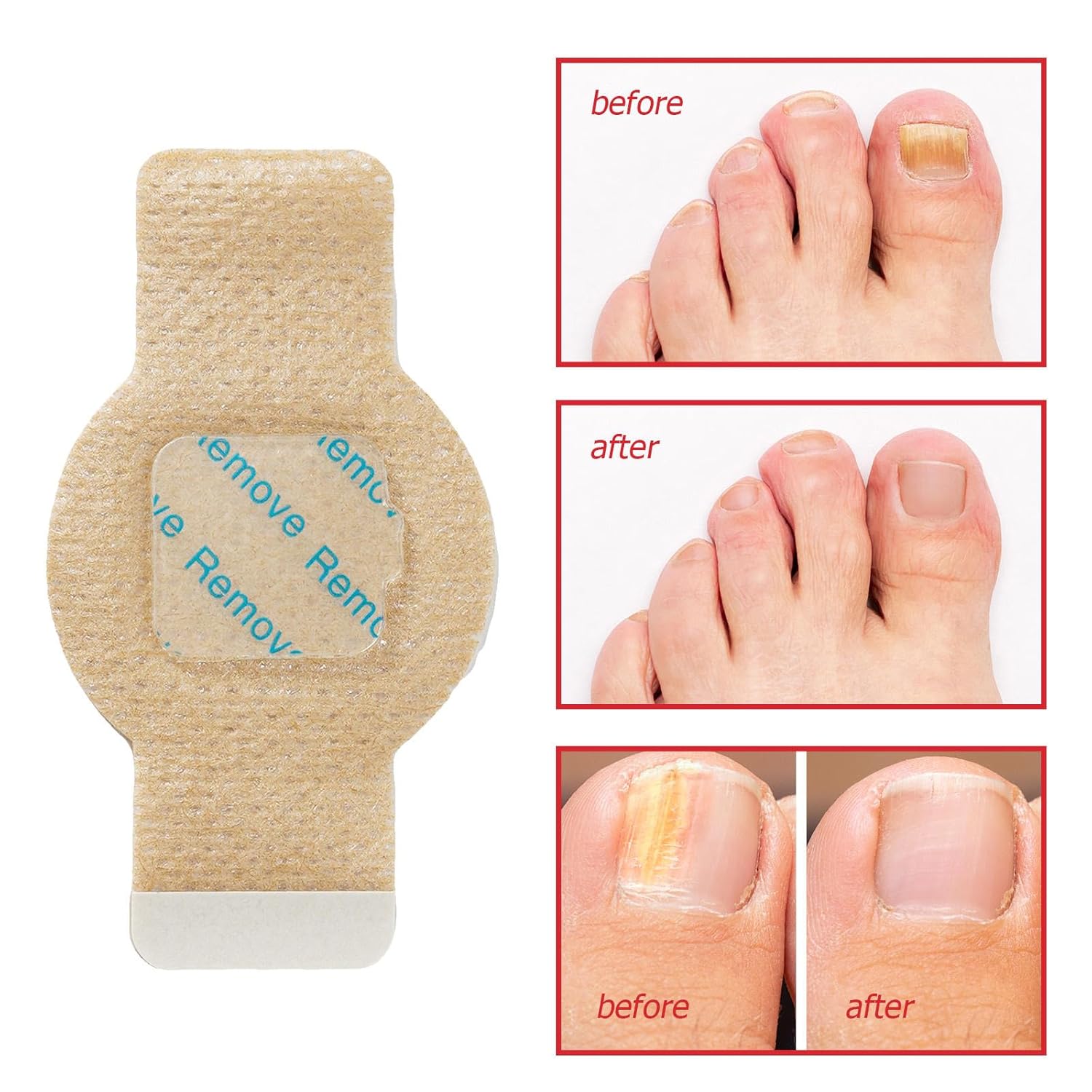 HealixNail – Antifungal Patch Therapy for Stronger Nails