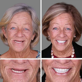 🌎Ends Today: 70% OFF! ⏰Yagoo™ Medical Full Denture with Strong Suctiond🦷Obtain American Dental Association (ADA) Certification