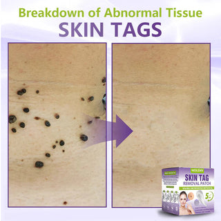 ClearDerma – Microneedle Skin Tag Removal Patch