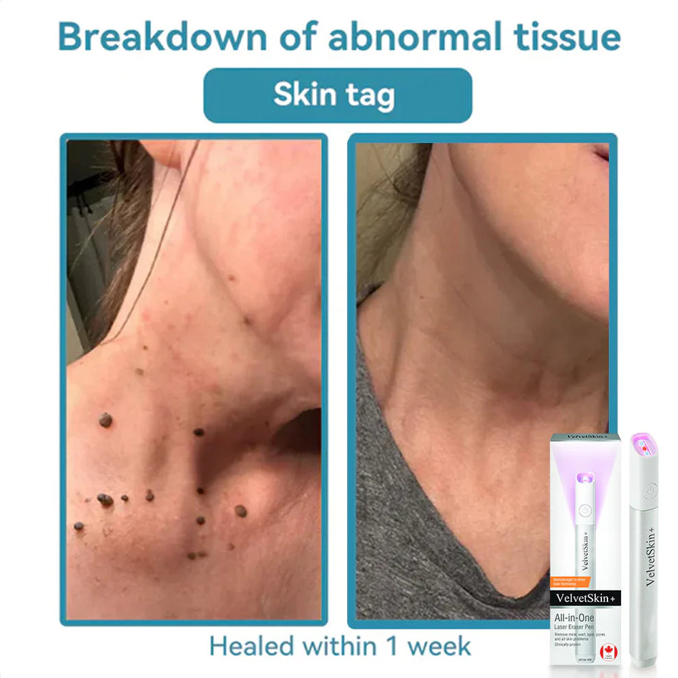 ClearDerm – CO₂ Laser Skin Correction Pen