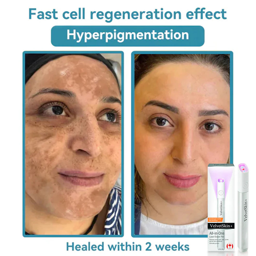 ClearDerm – CO₂ Laser Skin Correction Pen