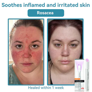 ✨VelvetSkin+™ All-in-One CO₂ Laser Eraser Pen | Removes Moles, Warts, Skin Flaws & Pigmentation
