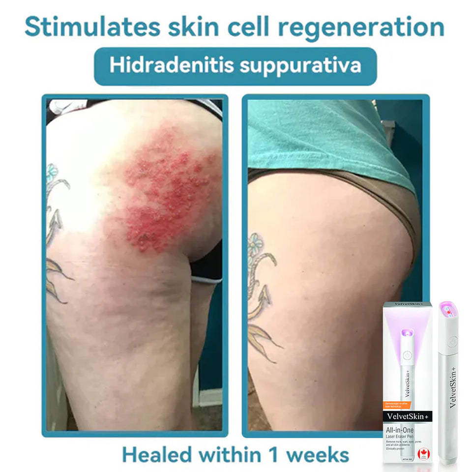 ClearDerm – CO₂ Laser Skin Correction Pen