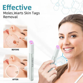 ✨VelvetSkin+™ All-in-One CO₂ Laser Eraser Pen | Removes Moles, Warts, Skin Flaws & Pigmentation