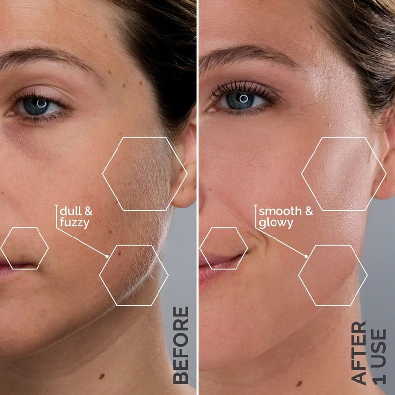 SilkSonic – Premium Facial Dermaplaning & Exfoliation Tool