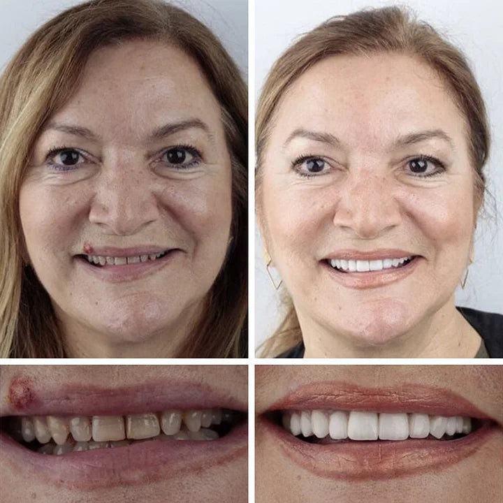 DentaGrip - Strong Suction Full Denture