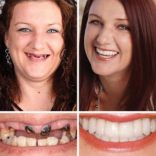 DentaGrip - Strong Suction Full Denture