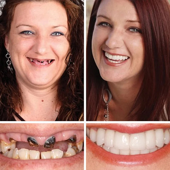 SmileAura - Natural Look Dentures