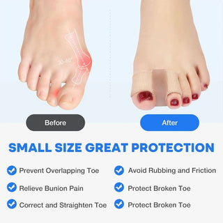 ToeAlign – Bunion Corrector System