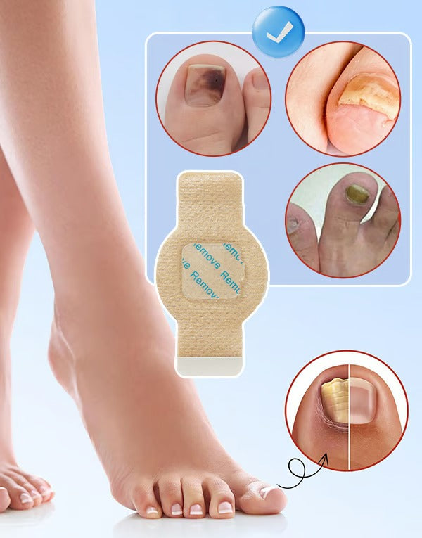 HealixNail – Antifungal Patch Therapy for Stronger Nails