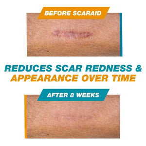 ScarEase – Invisible Healing Silicone Stick