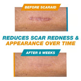 ScarEase – Invisible Healing Silicone Stick