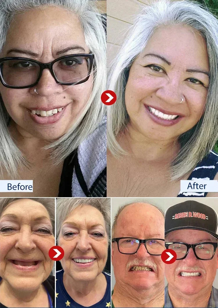 SmileRestore – Natural-Looking Full Dentures You Custom-Fit at Home in Minutes