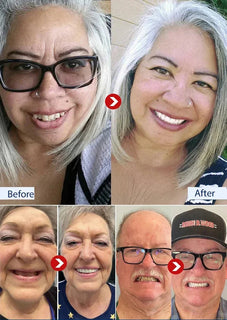 SmileRestore – Natural-Looking Full Dentures You Custom-Fit at Home in Minutes