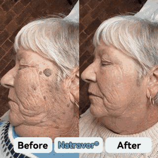 Natravor – 7-Day Skin Tag & Spot Eraser Cream