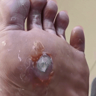 SandalEase – Bee Venom Wart, Corn & Callus Cream