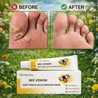 SandalEase – Bee Venom Wart, Corn & Callus Cream