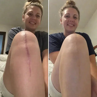 ScarCalm – Medical-Grade Silicone Scar Gel