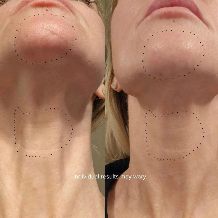 Before and after of a jawline and neck showing firmer skin and fewer fine lines after Equinox Pro LED mask use