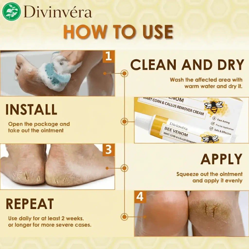 SandalEase – Bee Venom Wart, Corn & Callus Cream
