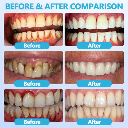 Kevyxa Gum Repair Gel
