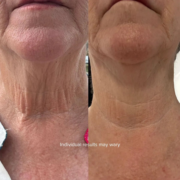 Before and after close-up showing smoother neck skin with reduced crepiness after Equinox Pro treatment