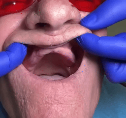 SmileRestore – Natural-Looking Full Dentures You Custom-Fit at Home in Minutes