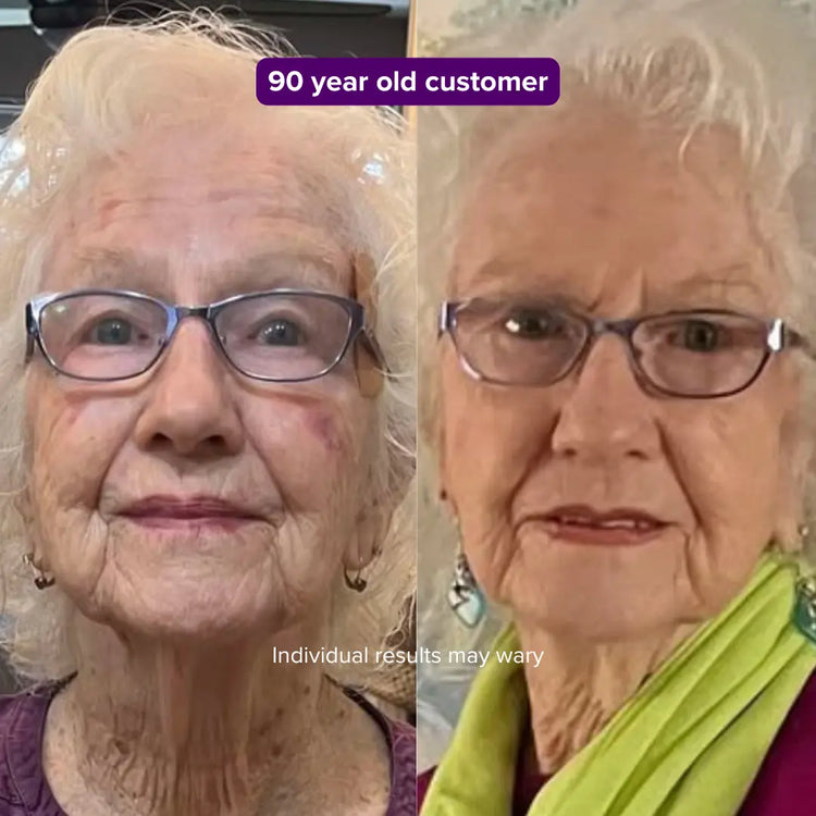 Before and after of a 90 year old customer showing smoother skin after using the Equinox Pro LED mask