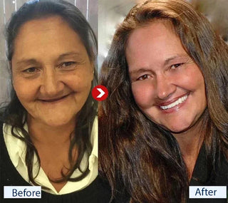 SmileRestore – Natural-Looking Full Dentures You Custom-Fit at Home in Minutes