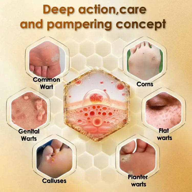 SandalEase – Bee Venom Wart, Corn & Callus Cream