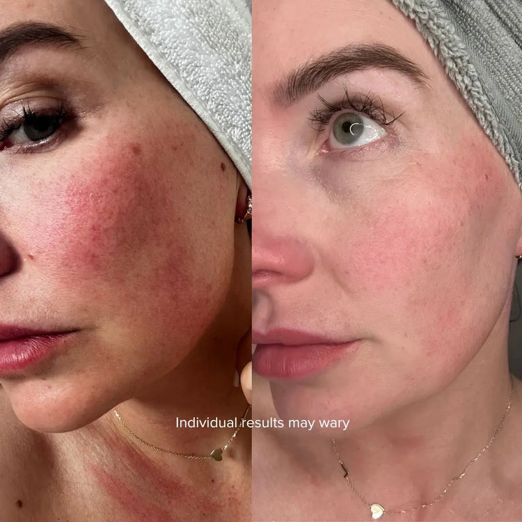 Before and after of a woman's cheek showing reduced redness and rosacea after using the Equinox Pro LED mask