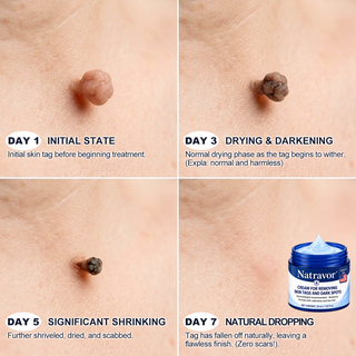 Natravor – 7-Day Skin Tag & Spot Eraser Cream