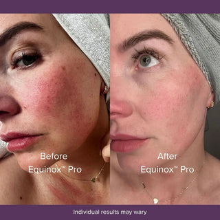LumaRenew – Equinox™ Pro LED Light Therapy Mask for Face, Neck & Chest