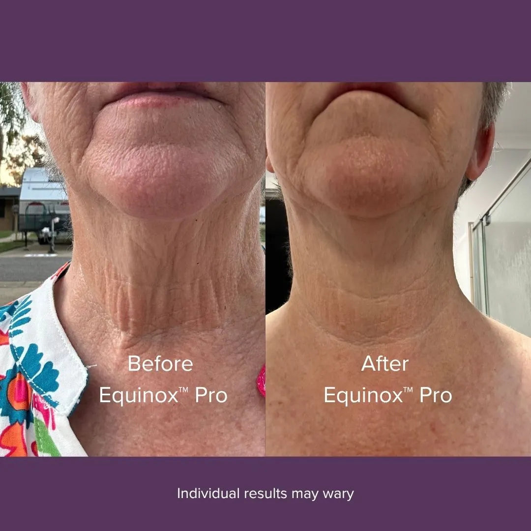 LumaRenew – Equinox™ Pro LED Light Therapy Mask for Face, Neck & Chest