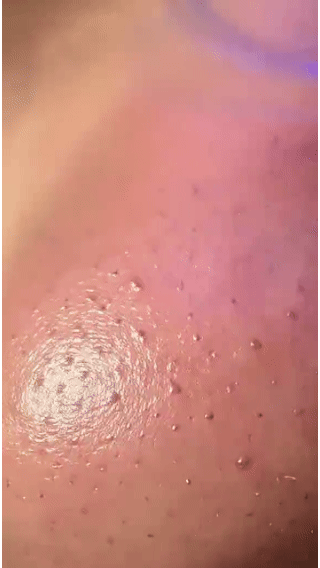 PoreGlide – Adjustable Blackhead Removal & Pore Cleaner