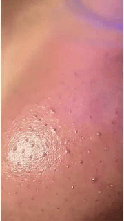 PoreGlide – Adjustable Blackhead Removal & Pore Cleaner