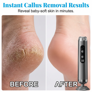HeelRenew – Foot Callus Remover Soft Skin Solution