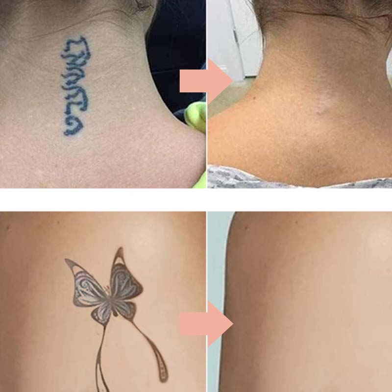 FadeEase – Gentle Tattoo Fading Cream